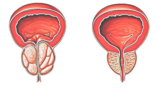 Prostatit ve normal prostat