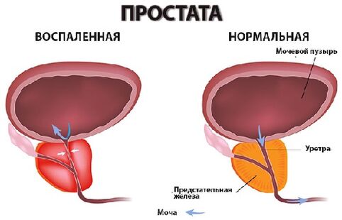 prostat