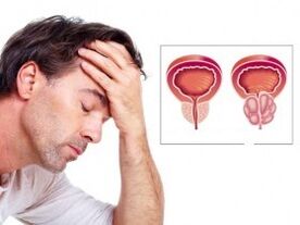 Bir erkekte prostatit