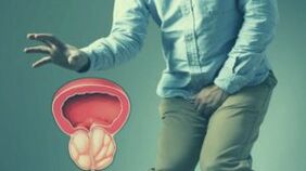 Akut prostatit