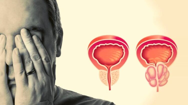 Bir erkeğin prostatiti vardır