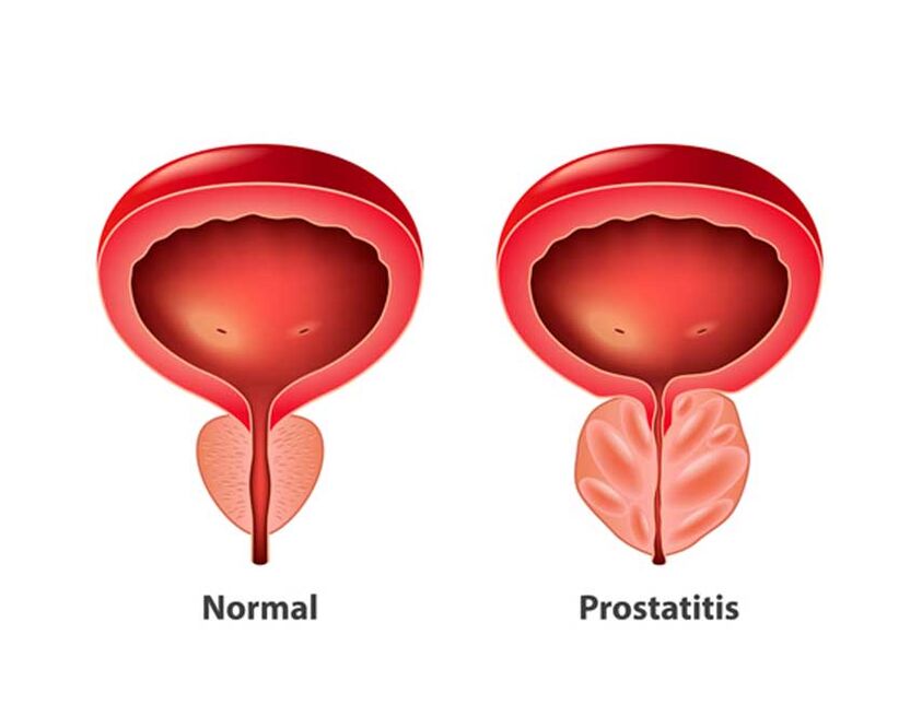 normal ve inflamatuar prostat